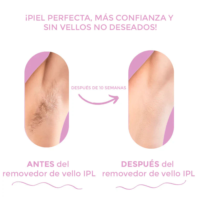 IPL Removedor de Vello | La mejor depiladora láser para usar en casa
